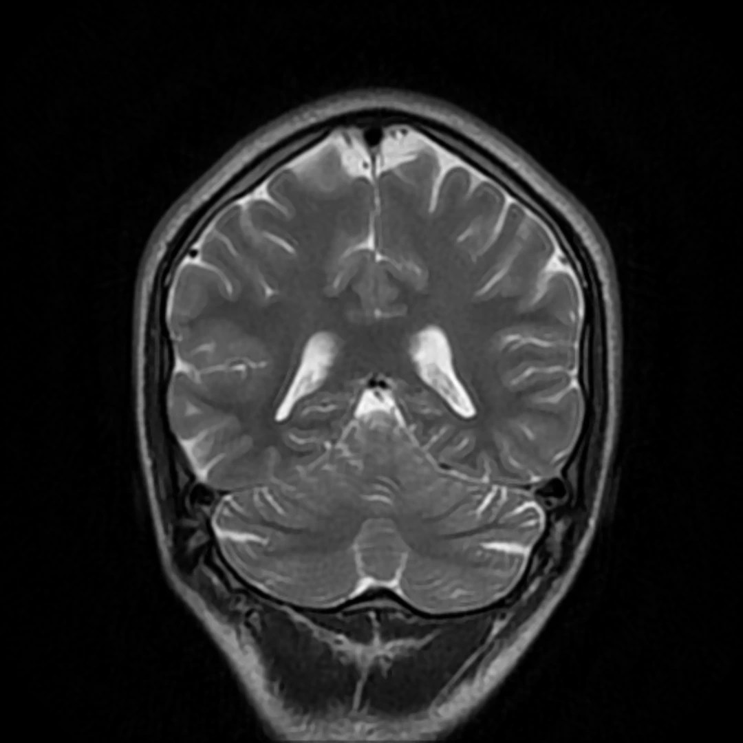 Coronal T2-weighted MRI showing the two cerebral hemispheres, ventricles and cerebellum in greyscale